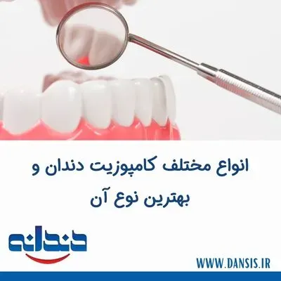 انواع مختلف کامپوزیت دندان و بهترین نوع آن